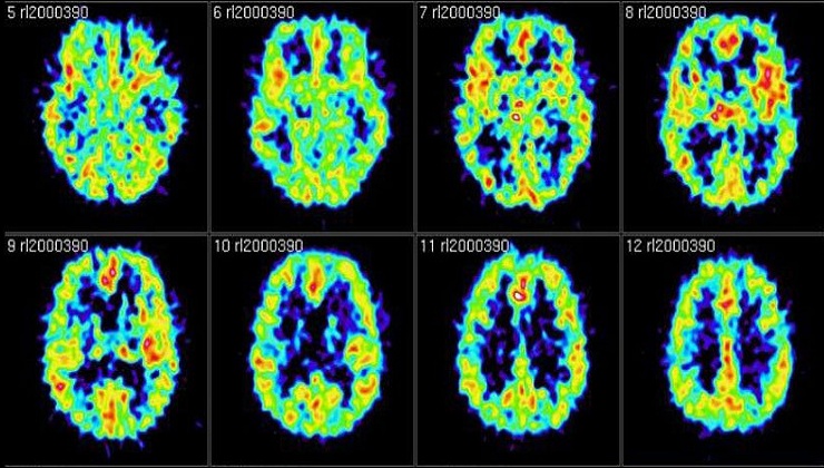 You can actively forget memories if you try, and Scientists have the Brain Scans to prove it