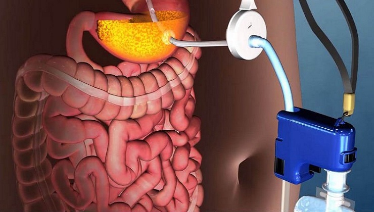 The FDA just approved this gross Weight-loss device that sucks Food from your Stomach
