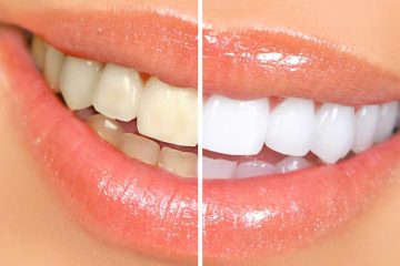 How to Naturally Whiten your Teeth at Home in 3 Minutes