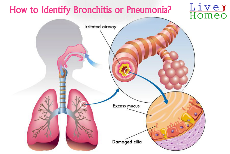 How to tell the difference between Bronchitis and Pneumonia