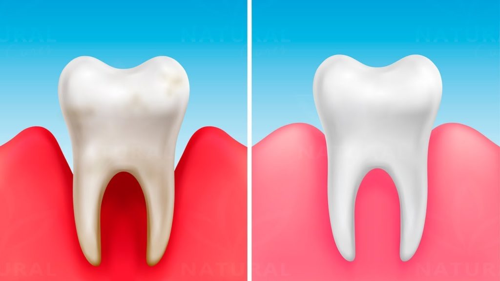 These Vitamins can prevent Cavities and make your Teeth stronger