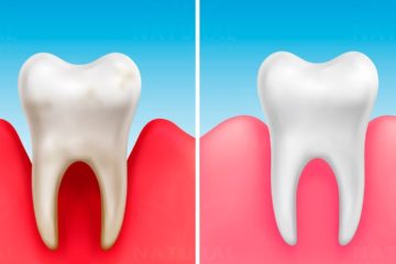 These Vitamins can prevent Cavities and make your Teeth stronger