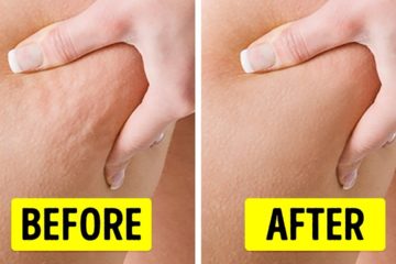 5 ways to reduce Cellulite on your Body