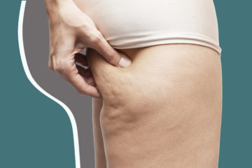 How to quickly get rid of Cellulite