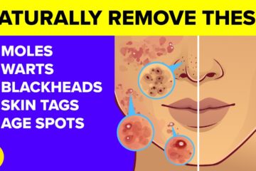 Destroy your Moles, Warts, Blackheads, Skin Tags and Age spots completely naturally