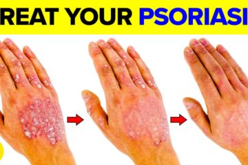 14 Foods that are Great for Fighting your Psoriasis
