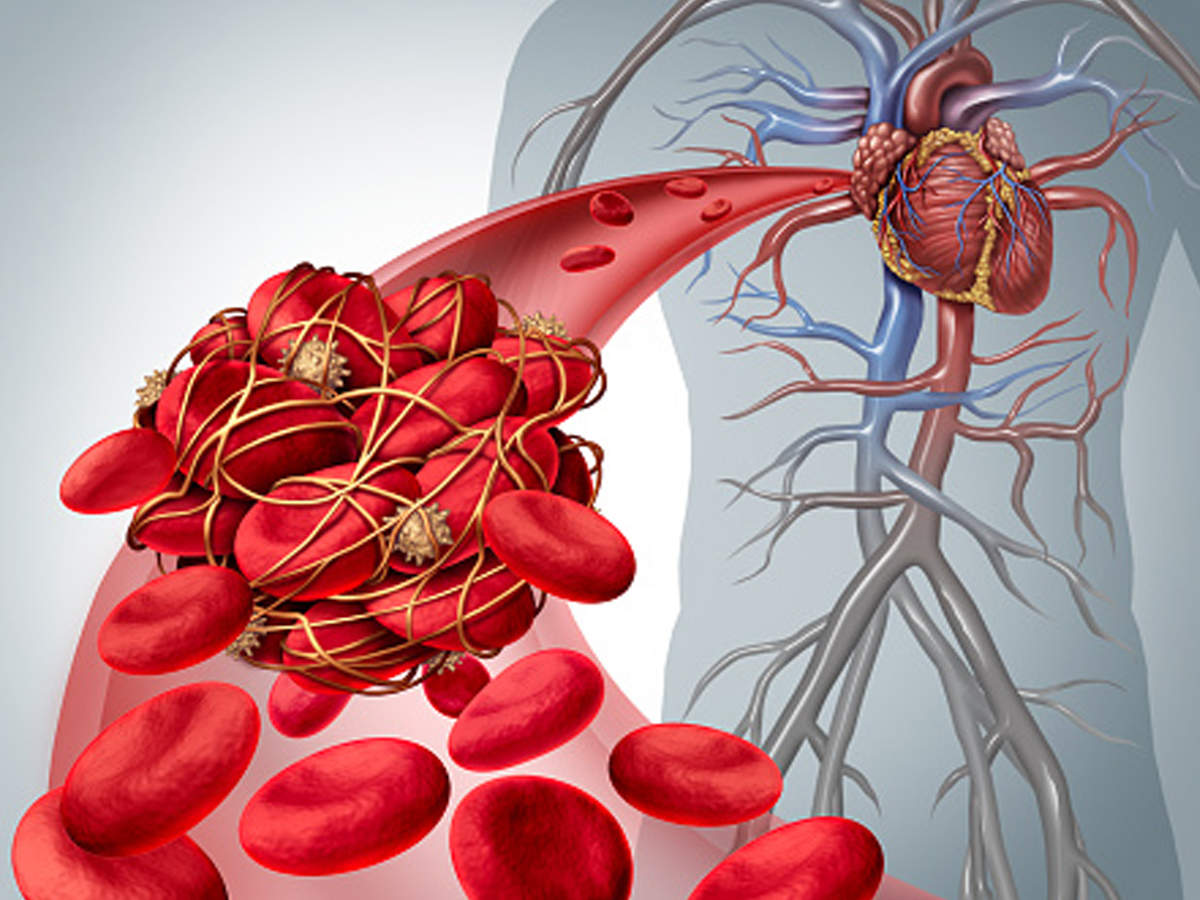 How to Stop a Blood Clot before it Starts Sports Health & WellBeing