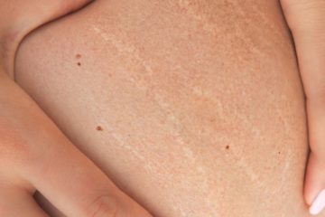 Make Stretch Marks Disappear with these Easy Steps
